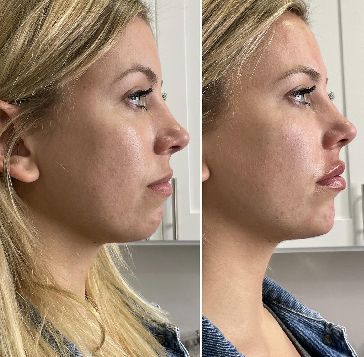 https://www.theperfectdose.com/wp-content/uploads/2024/10/Chin-Filler-bxa.jpg