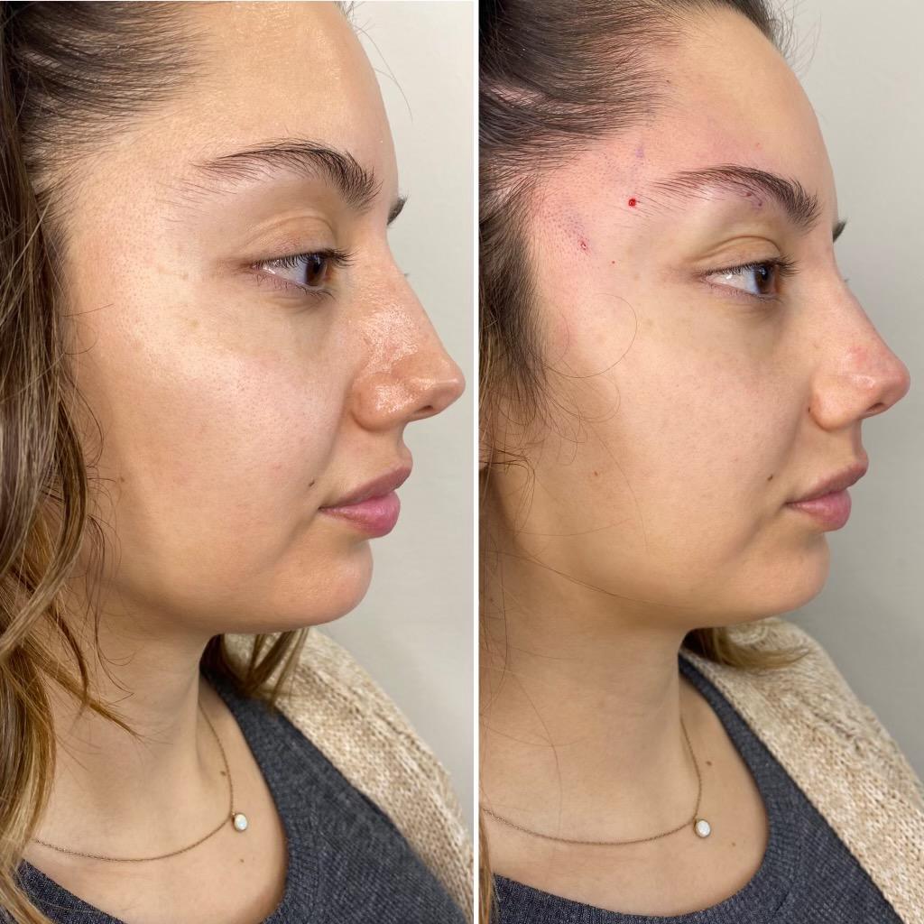 https://www.theperfectdose.com/wp-content/uploads/2024/10/Non-surgical-rhinoplasty-bxa2.jpg