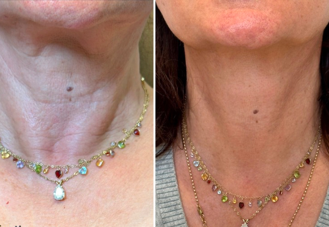 https://www.theperfectdose.com/wp-content/uploads/2025/02/neck-rejuvenation.jpg