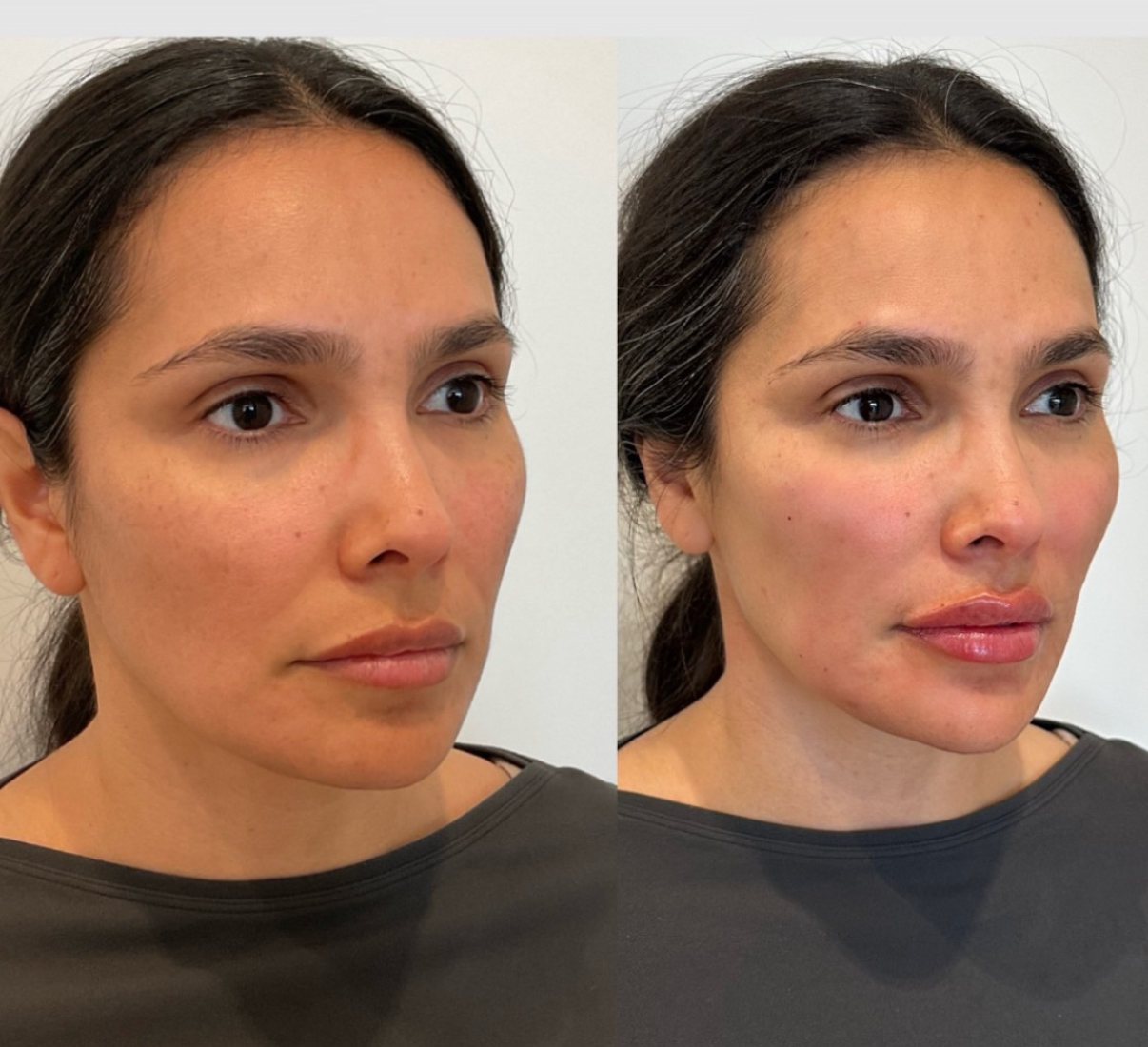 https://www.theperfectdose.com/wp-content/uploads/2025/07/full-facial-balancing-sculptra-filler.jpeg