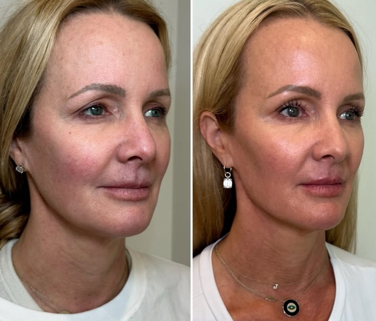 https://www.theperfectdose.com/wp-content/uploads/2025/07/sculptra-b_a-1.jpeg