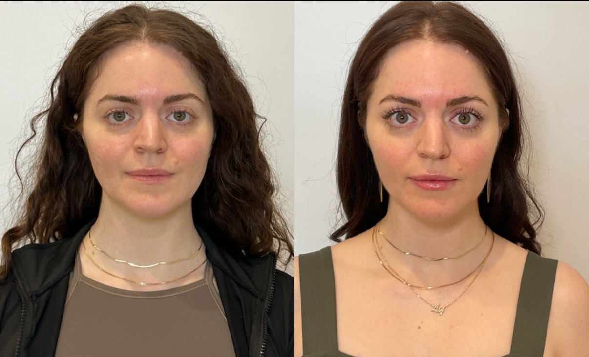 https://www.theperfectdose.com/wp-content/uploads/2025/07/sculptra-filler.jpeg